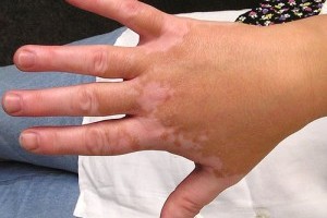 Mit tehetünk a fehér foltok (vitiligo) ellen?